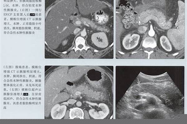 80公斤的急性胰腺炎患者,给予肠外营养补