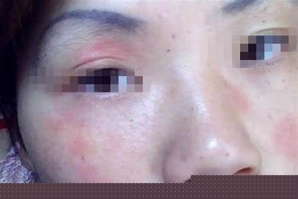 做面膜皮肤过敏了，该用什么药好的快